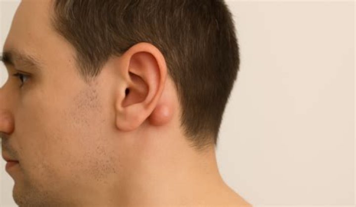 Cillian Murphy's Mysterious Lump Behind Ear: Explained