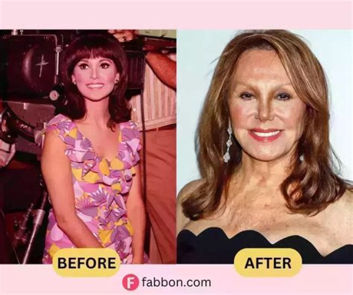 Marlo Thomas: Before & After Plastic Surgery