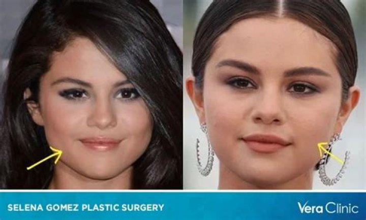 Selena Gomez Undergoes Eye Surgery: Reasons And Recovery