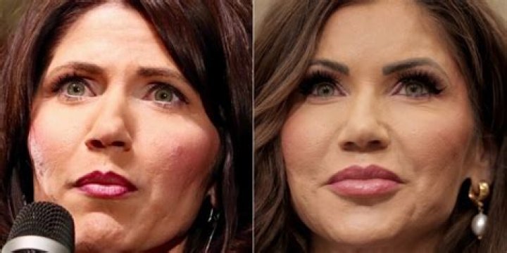 The Startling Transformation: Before And After Kristi Noem's Plastic Surgery