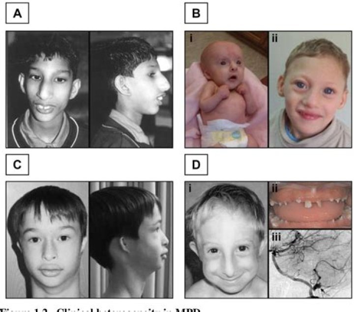 Unveiling The Enigmatic World Of Rare Dwarfism: Discoveries And Insights